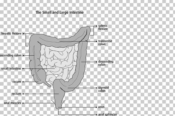 Colectomy Bowel Resection Large Intestine Surgery Sigmoid Colon PNG, Clipart, Angle, Area, Bone, Colectomy, Colic Flexures Free PNG Download