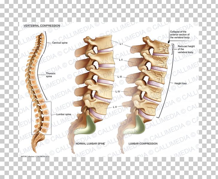 Vertebral Compression Fracture Vertebral Column Lumbar Vertebrae Bone Fracture PNG, Clipart, Bone, Bone Fracture, Cervical Vertebrae, Humerus, Injury Free PNG Download