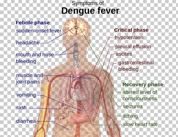 Dengue Virus Viral Hemorrhagic Fever Symptom PNG, Clipart, Abdomen, Angle, Arm, Dengue Fever, Disease Free PNG Download