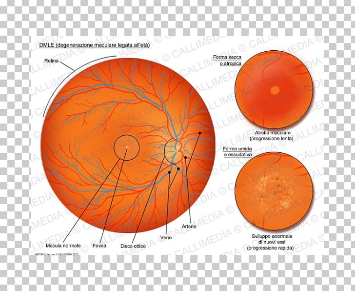 Macular Degeneration Macula Of Retina Old Age Atrophy PNG, Clipart, Age ...