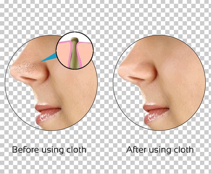 Comedo Skin Nose Exfoliation Pimple PNG, Clipart, Acne, Cheek, Chin, Comedo, Cosmetics Free PNG Download