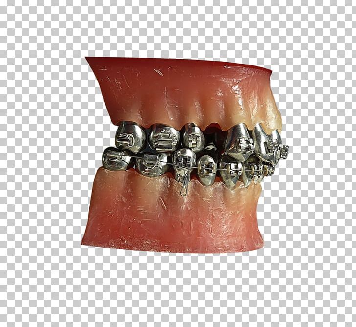 Human Tooth Metal Jaw PNG, Clipart, Art, Artist, Community, Dental Braces, Deviantart Free PNG Download
