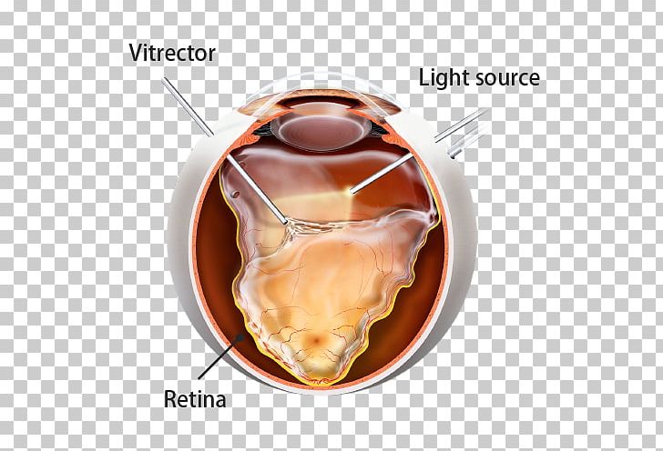Retinal Detachment Vitrectomy Surgery Eye PNG, Clipart, Animal Source Foods, Caramel Color, Cataract, Disease, Eye Free PNG Download