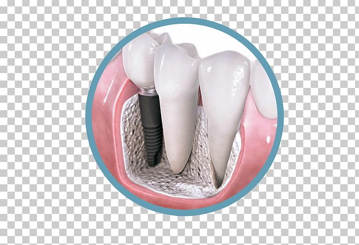 Dental Implant Dentistry Dental Surgery PNG, Clipart, Cosmetic Dentistry, Crown, Dental Extraction, Dental Implant, Dental Implants Free PNG Download