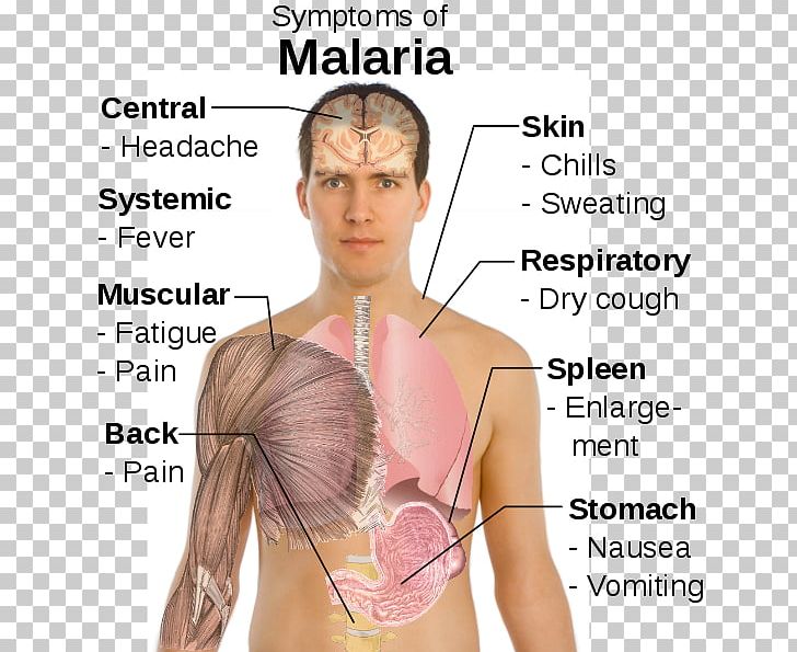 Malaria Symptomatic Treatment Chills Plasmodium Falciparum PNG, Clipart, Abdomen, Active Undergarment, Antimalarial Medication, Arm, Chills Free PNG Download