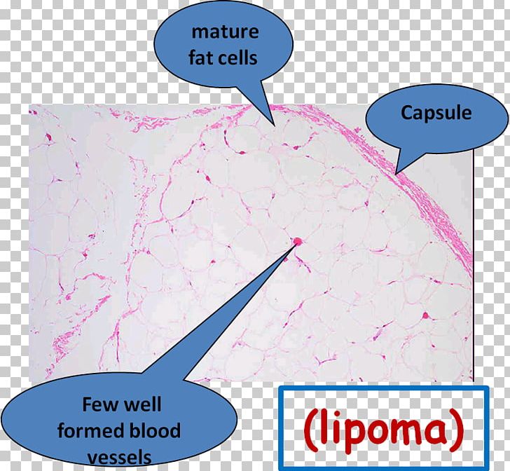 Neoplasm Tissue Water PNG, Clipart, Ak 47, Area, Caliphate, Concept, Line Free PNG Download