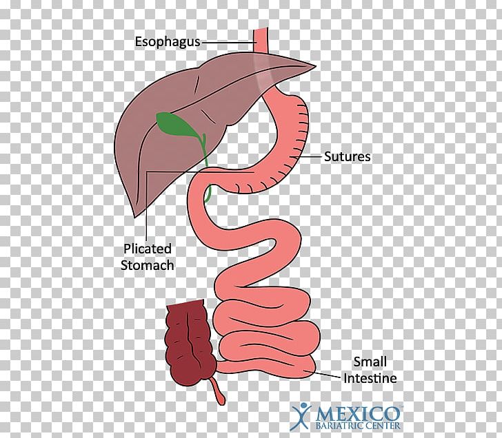 Duodenal Switch Bariatric Surgery Sleeve Gastrectomy Gastric Bypass Surgery PNG, Clipart,  Free PNG Download