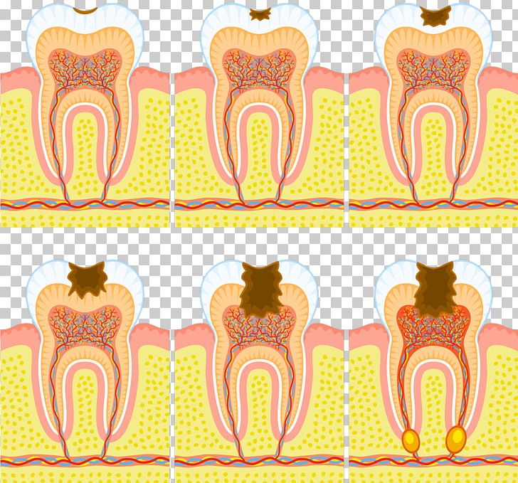 Tooth Decay Dentistry Pulp Human Tooth Dental Abscess PNG, Clipart, Dental Abscess, Dental Restoration, Dentin, Dentistry, Disease Free PNG Download