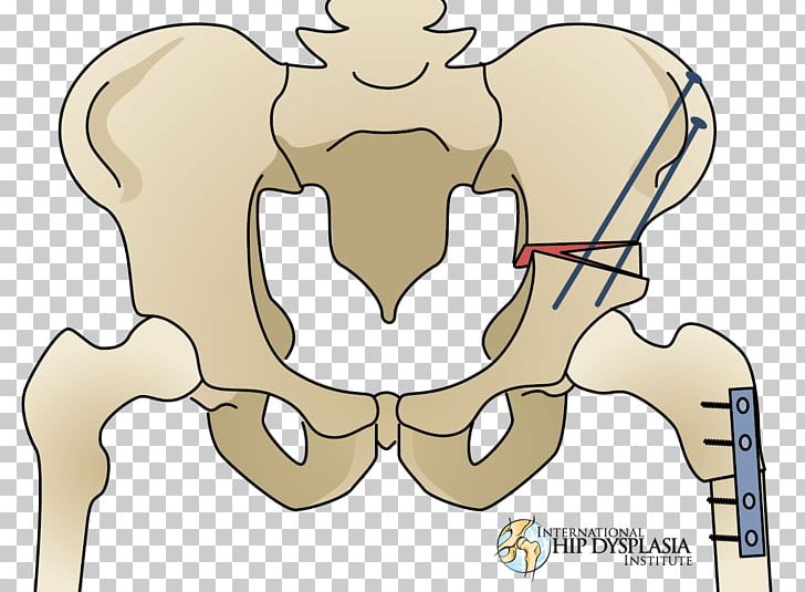 Osteotomy Hip Dysplasia Surgery Therapy PNG, Clipart, Arm, Arthroscopy, Carnivoran, Cartoon, Dentist Free PNG Download