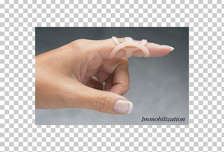 Thumb Splint Swan Neck Deformity Mallet Finger Boutonniere Deformity PNG, Clipart, Arthritis, Band Aids, Deformity, Finger, First Aid Kits Free PNG Download