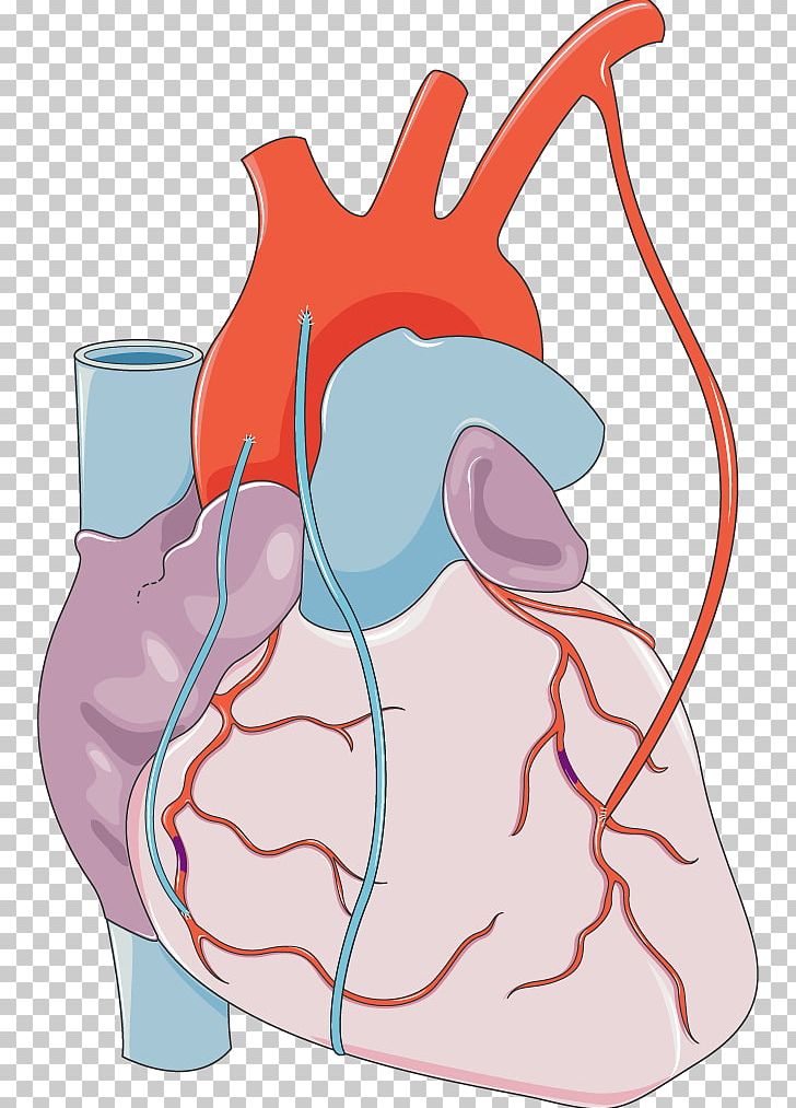 Coronary Artery Bypass Surgery Myocardial Infarction Cardiology Coronary Arteries PNG, Clipart, Art, Artery, Artwork, Bypass Surgery, Cardi Free PNG Download