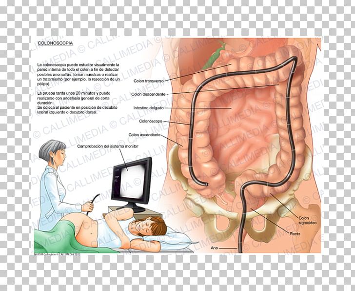 Virtual Colonoscopy Zollinger–Ellison Syndrome Diverticulosis PNG, Clipart, Abdomen, Arm, Cecum, Chest, Colonoscopy Free PNG Download