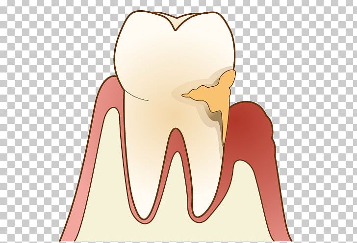 Periodontal Disease Gums 歯科 Dentist Dental Plaque PNG, Clipart, Alveolar Process, Dental Calculus, Disease, Ear, Elephant Free PNG Download