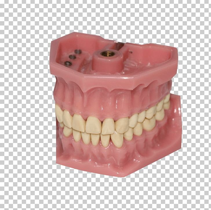 Dentistry Human Tooth Dentures Bruxism PNG, Clipart, Bridge, Bruxism, Crown, Dental Surgery, Dentist Free PNG Download