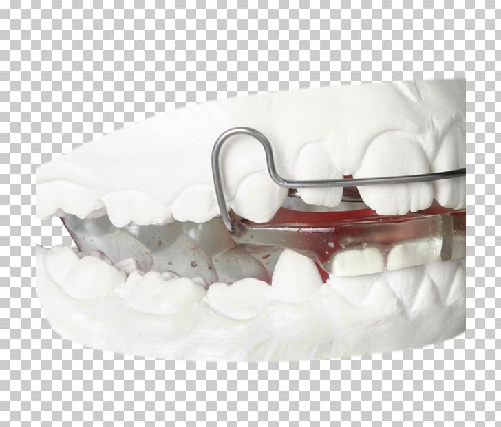 Gergen's Orthodontic Lab Orthodontics Orthodontic Technology Jaw Gergens Orthodontic Lab PNG, Clipart,  Free PNG Download