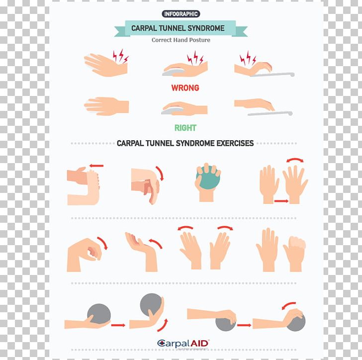 Carpal Tunnel Syndrome Exercise Hand Wrist Pain PNG, Clipart, Carpal Bones, Carpal Tunnel, Carpal Tunnel Syndrome, Chronic Pain, Exercise Free PNG Download