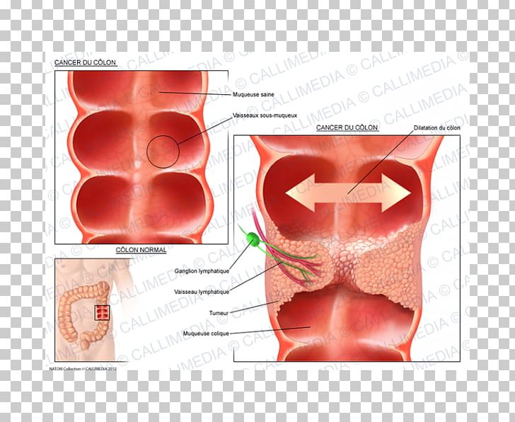 Illustration Anatomique Ductal Carcinoma In Situ Oncology PNG, Clipart, Banco De Imagens, Breast Cancer, Ductal Carcinoma In Situ, Hematology, Illustration Anatomique Free PNG Download