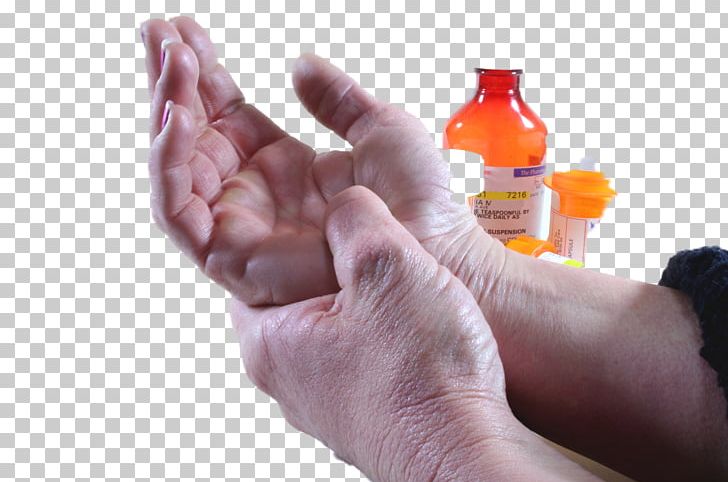 Joint Arthritis Ache Symptom Peripheral Neuropathy PNG, Clipart, Ache, Arm, Arthritis, Diabetes Mellitus, Diabetic Neuropathy Free PNG Download