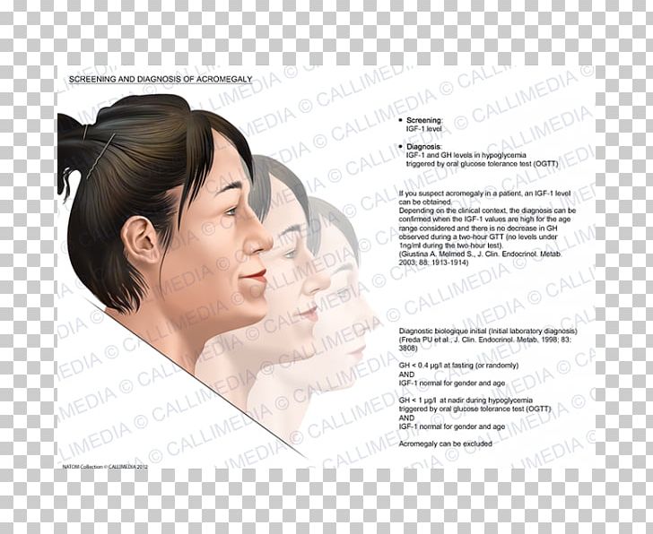 Acromegaly Diagnose Symptom Medical Diagnosis PNG, Clipart, Beauty, Cheek, Chin, Diabetes Mellitus, Diagnose Free PNG Download