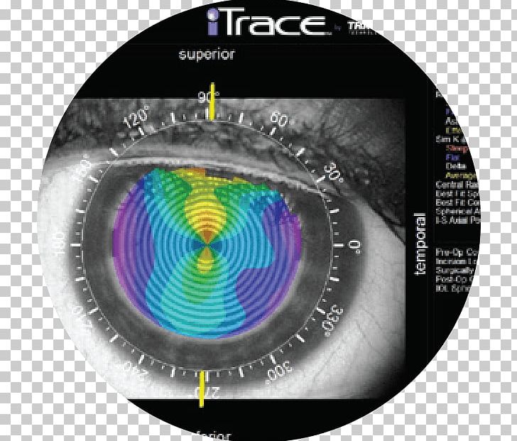 Ophthalmology Eye Examination Astigmatism Far-sightedness PNG, Clipart, Abbildungsfehler, Astigmatism, Cataract, Circle, Eye Free PNG Download
