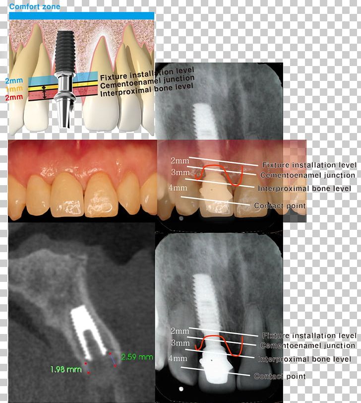 Dental Implant Cementoenamel Junction Tooth Dentistry Maxillary Sinus PNG, Clipart, Abutment, Anatomy, Cementum, Crown, Dental Implant Free PNG Download