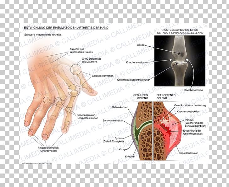 Rheumatoid Arthritis Disease Therapy Chronic Childhood Arthritis PNG, Clipart, Arthritis, Chronic Childhood Arthritis, Diagram, Ear, Finger Free PNG Download