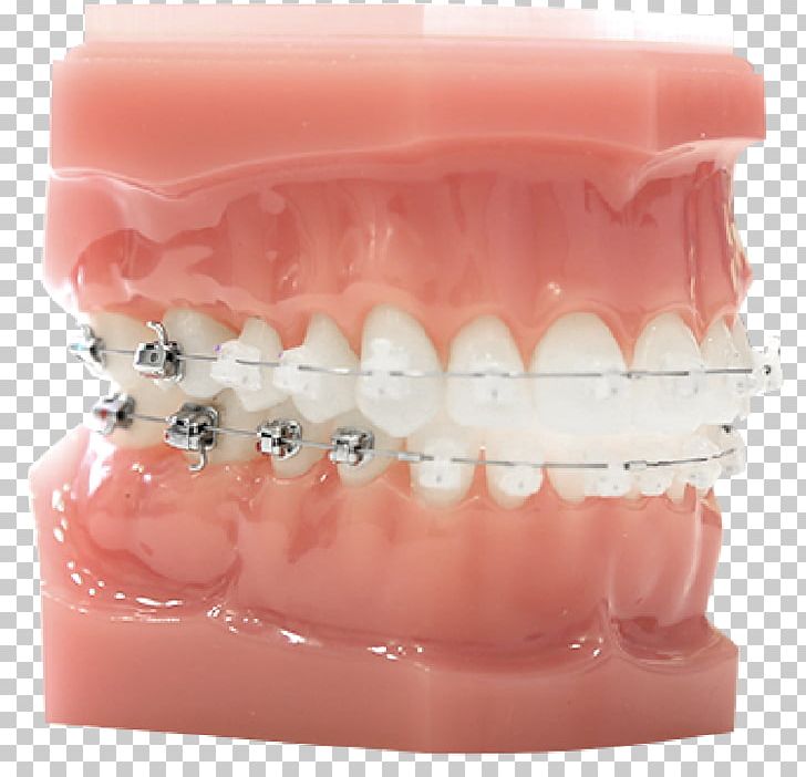 Tooth Damon System Dental Braces Dentistry ファミリエ歯科クリニック PNG, Clipart, Adhesion, Apparaat, Child, Clinic, Cosmetic Dentistry Free PNG Download