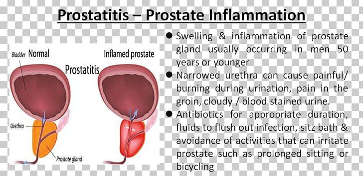 prostatitis por candidiasis