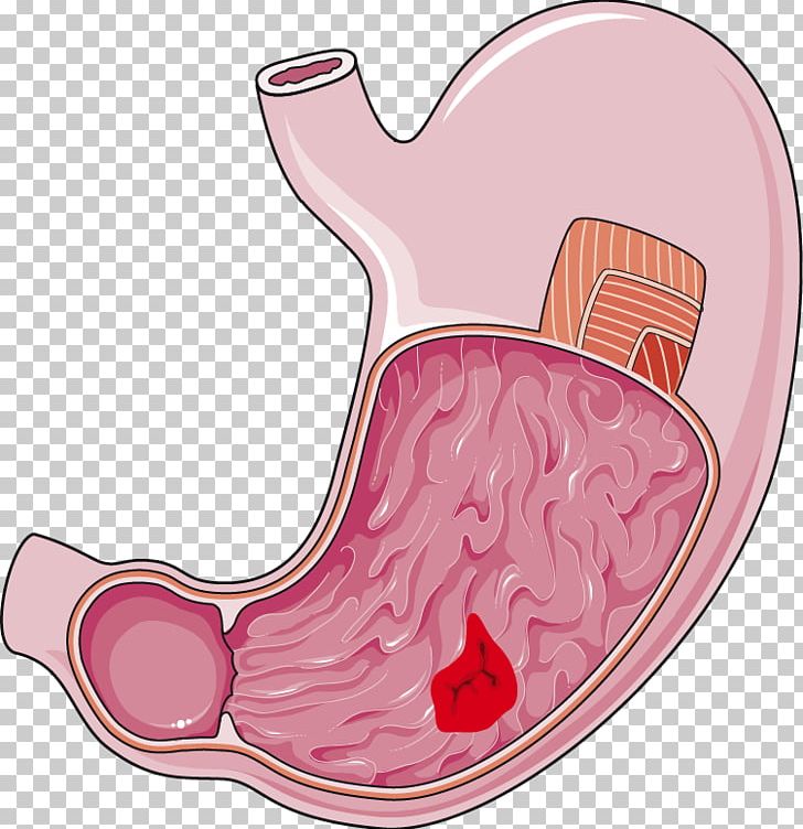 Stomach Peptic Ulcer Disease Digestion Small Intestine PNG, Clipart, Abdomen, Art, Gastric Acid, Gastroenterology, Gastroesophageal Reflux Disease Free PNG Download