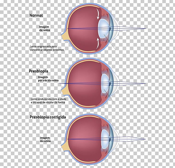 Presbyopia Progressive Lens Ophthalmology Near-sightedness PNG, Clipart, Angle, Cataract, Cataract Surgery, Circle, Clinica Free PNG Download