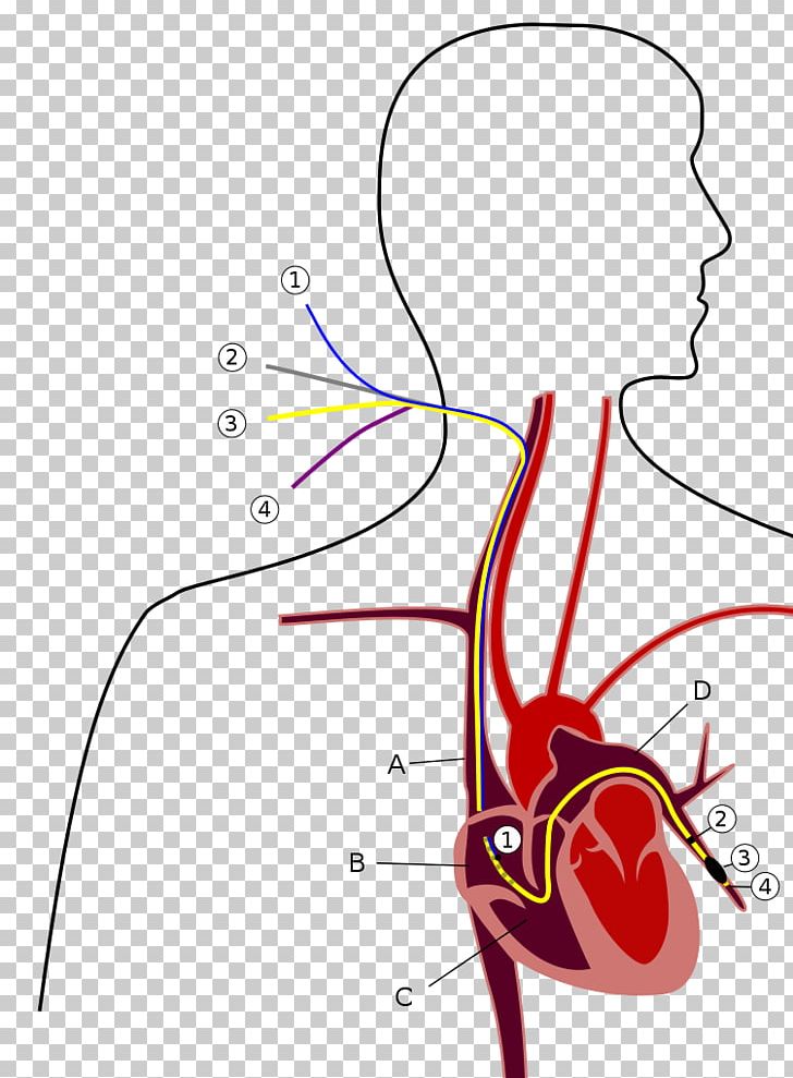 Pulmonary Artery Catheter Pulmonary Hypertension Pulmonary Wedge Pressure PNG, Clipart, Angle, Area, Arm, Art, Artery Free PNG Download