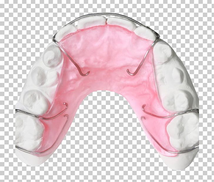 Retainer Orthodontics Orthodontic Technology Jaw Bionator PNG, Clipart, Album, Bionator, Breathing, David Gergen, Dental Degree Free PNG Download