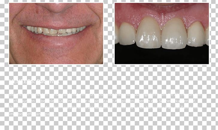 DiPura Tooth Whitening Veneer Zahnfarbe PNG, Clipart, Bridge, Chin, Cosmetic Dentistry, Demonstration, Dental Clinic Free PNG Download
