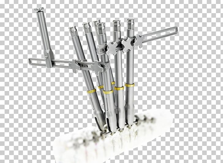 Vertebral Column Adult Scoliosis Adolescent Idiopathic Scoliosis Surgery PNG, Clipart, Angle, Cylinder, Deformity, Depuy Synthes Companies, Hardware Accessory Free PNG Download