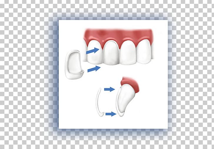 Veneer Cosmetic Dentistry Crown PNG, Clipart, Cosmetic Dentistry, Crown, Dental Composite, Dental Implant, Dental Porcelain Free PNG Download