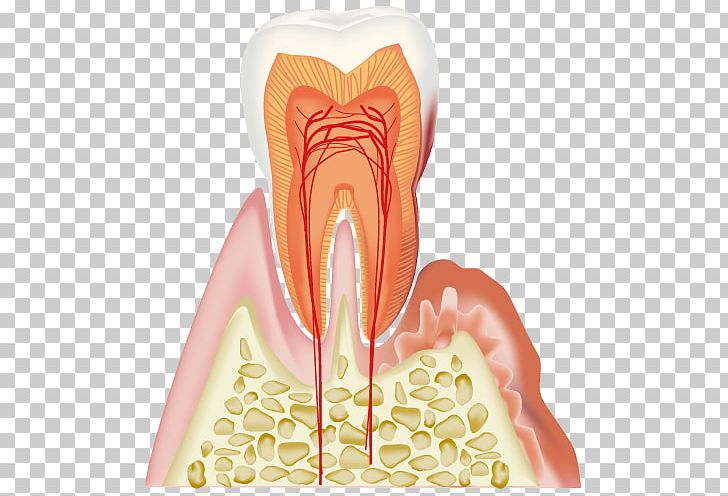 Periodontal Disease Dentistry Gums PNG, Clipart, Alveolar Process, Dental Surgery, Dentist, Dentistry, Dentures Free PNG Download