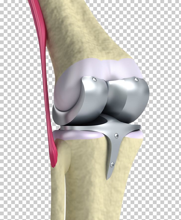 Knee Replacement Joint Replacement Surgery Prosthesis PNG, Clipart, Arm, Diz, Finger, Hinge Joint, Hip Free PNG Download