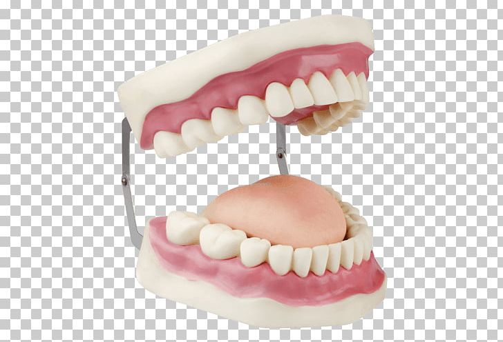 Dentures Dentistry Dental Instruments Human Tooth Dental Implant PNG, Clipart, Dental College, Dental Implant, Dental Instruments, Dental Laboratory, Dental Prosthesis Free PNG Download