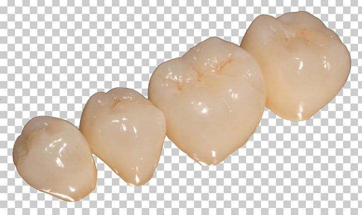 Dentures Prótesis Fija Tooth Crown Dentist PNG, Clipart, Ceramic, Crown, Dentist, Dentures, Laboratory Free PNG Download