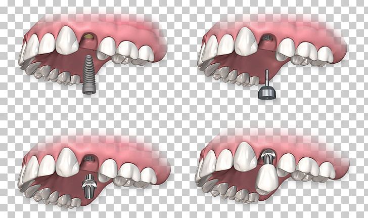 Dental Implant Dentistry Dentures PNG, Clipart, Abutment, Bone, Crown, Dental, Dental Implant Free PNG Download