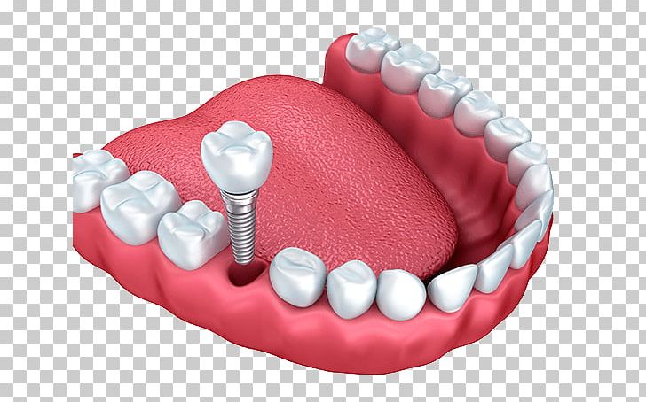 Dental Implant Dentistry Tooth PNG, Clipart, Crown, Dental, Dental Care, Dental Extraction, Dental Implant Free PNG Download