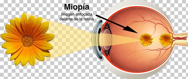Human Eye Astigmatism Near-sightedness Far-sightedness PNG, Clipart, Astigmatism, Cornea, Eye, Farsightedness, Flower Free PNG Download