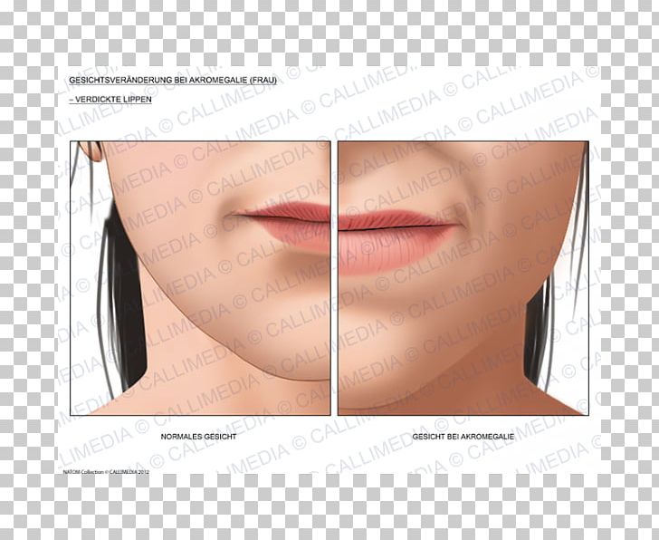 Acromegaly Face Diabetes Mellitus Lip Surgery PNG, Clipart, Acromegaly, Cheek, Chin, Cosmetics, Diabetes Free PNG Download