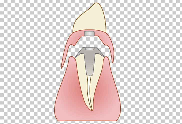 ふれあいファミリー歯科 Dentist Tooth Bridge Dental Implant PNG, Clipart, Bridge, Dental Implant, Dentist, Dentures, Implant Free PNG Download