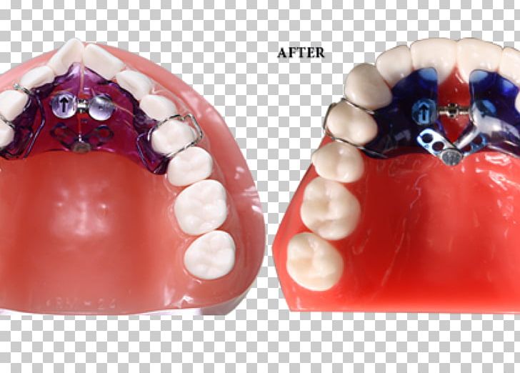 Orthodontics Home Appliance Palatal Expansion Orthodontic Technology Jaw PNG, Clipart, Arch, Augers, Clear Aligners, Crossbite, Dental Arch Free PNG Download