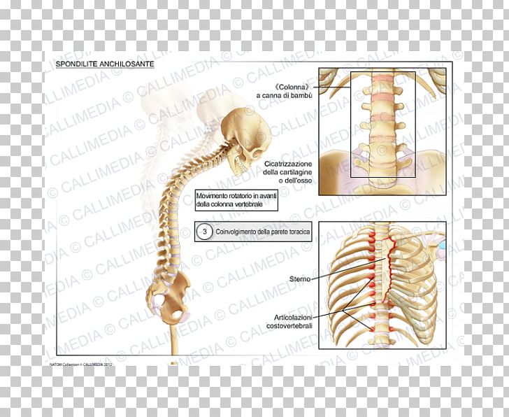 Ankylosing Spondylitis National Institute Of Arthritis And Musculoskeletal And Skin Diseases Rheumatology Ankylosis PNG, Clipart, Angle, Ankylosing Spondylitis, Ankylosis, Arm, Bone Free PNG Download