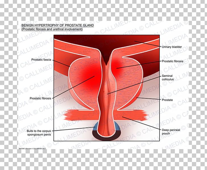 Benign Prostatic Hyperplasia Prostate Cancer Hypertrophy Tadalafil PNG, Clipart, Angle, Benign Tumor, Diagram, Erectile Dysfunction, Gland Free PNG Download