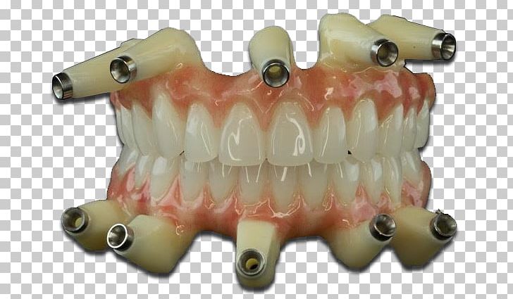 Dental Laboratory Dentures TC Dental Lab Dentistry Jaw PNG, Clipart, Com, Dental Laboratory, Dental Model, Dentistry, Dentures Free PNG Download