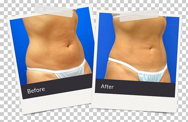 East Brunswick Township Body Contouring Surgery After Weight Loss Liposuction Body Contouring Surgery After Weight Loss PNG, Clipart, Abdomen, Abdominoplasty, Active Undergarment, Bariatrics, Before After Free PNG Download