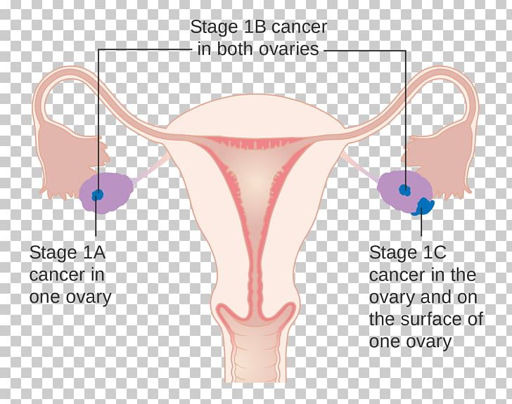 Ovarian Cancer Cancer Staging Ovary Cancer Research UK PNG, Clipart, Abdomen, Angle, Arm, Breast Cancer, Cancer Free PNG Download